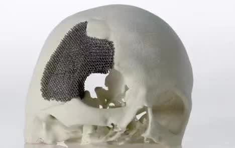 顱骨3D打印技術是什么？